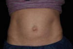 Coolsculpting - Case #2 Before